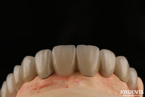 Porcelana PFM stopiona do metalowych koron i mostów Bezszwedzka wiązanie dla naturalnych uśmiechów