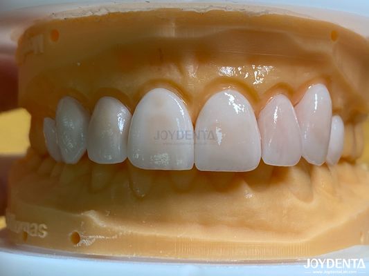 Lekkie i gładkie finery dentystyczne odporne na plamy Długa trwałość dla optymalnego komfortu