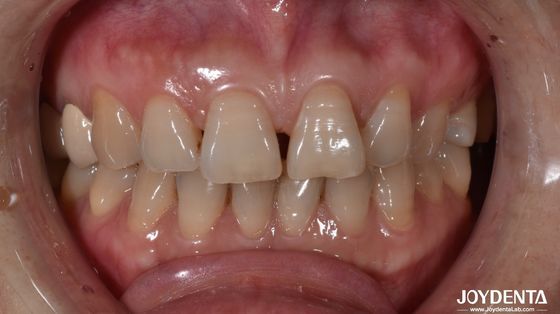 0.5mm grubość ceramiczne fałdy dentystyczne naturalne szukające wskazania zęba przedniego