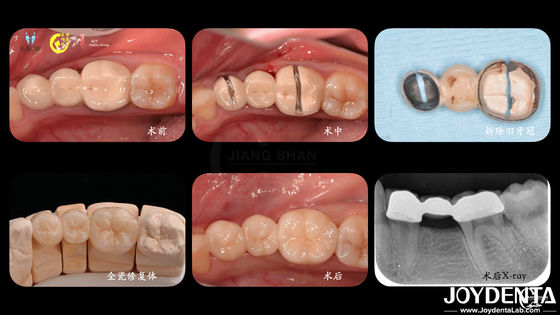 Dentalne korony z cyrkonii Biokompatybilność Komfort personalizacja dla optymalnego doświadczenia pacjenta