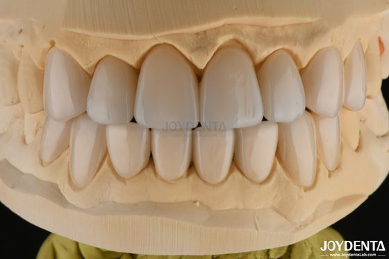 0.3-0.5mm Gęsta Felspatyczna Porcelanowa Folia Wysoka odporność na złamania Ulepsz Twój Uśmiech