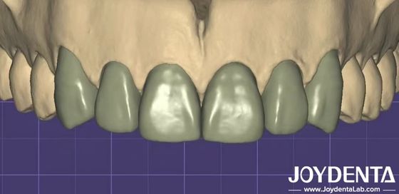 Drukowanie 3D Wirtualny cyfrowy wosk Bezproblemowa kompatybilność z innym oprogramowaniem stomatologicznym