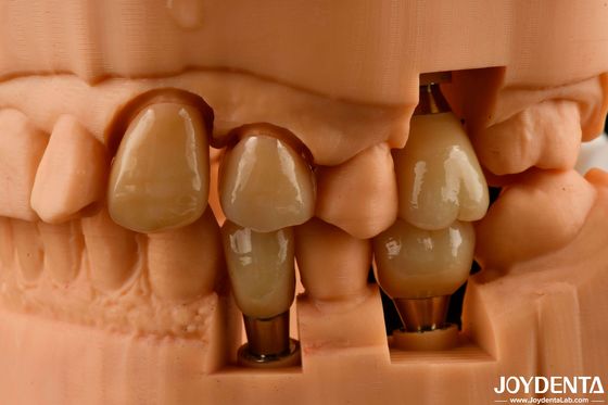 Działający na zamówienie implant korony i mostu, który zapewnia naturalny wygląd i długotrwałe efekty