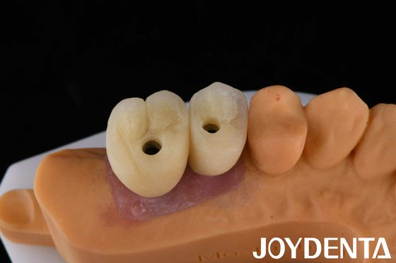 Korona i most z porcelanowego implantu - ostateczne rozwiązanie dla zębów brakujących