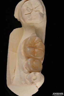 Emax Dental Inlays And Onlays Odporne na złamania 1,5 mm Niska przejrzystość