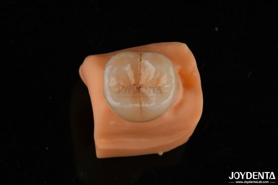 0.5mm Odporny na plamy Emax Inlay Onlay Precyzyjne dopasowanie do restauracji zębów