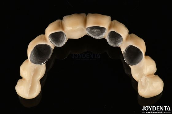 PFM Ceramic Fused To Metal Crown Wysoce biokompatybilny i odporny na korozję