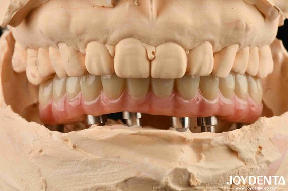 Estetyczny Titanium Malong Hybrid Dental Implant Bridge dla perfekcji zębów