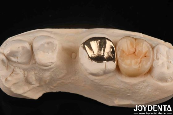 Niestandardowa korona dentystyczna z 60K metalowej