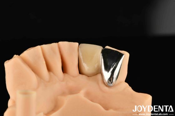 Zębowy Metal / Maryland Bridege Oral Clinical Repair Metallic Ideal Color Clinical Bonding