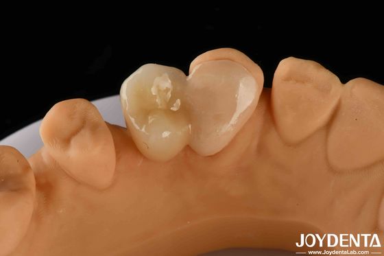 Emax Maryland Veneer Clinical Bonding Adhesion For Color Matching Dental Repair (Kliniczne przyczepienie zębów do odwracania kolorów)