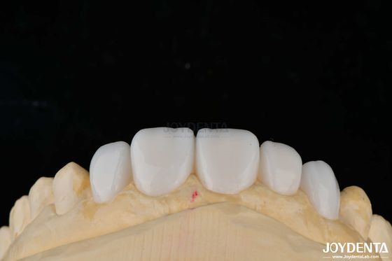 Materiał porcelanowy Emax Zębowe finery do wysokiej estetyki wiązania