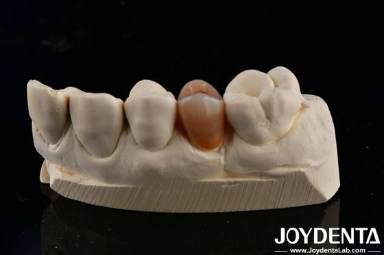 Biokompatybilny i naturalnie wyglądający wielowarstwowy cyrkon z estetyką