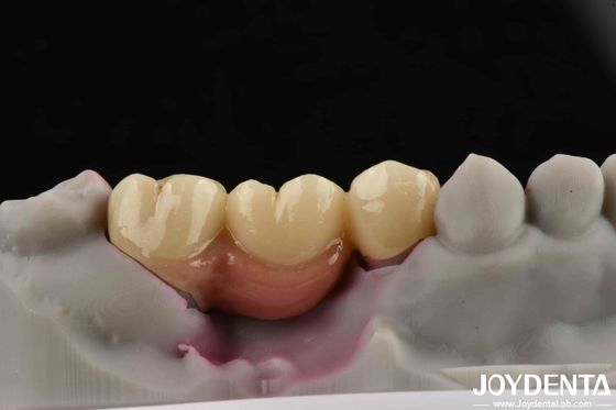 Zastosowalny most i korona z implantami zębnymi