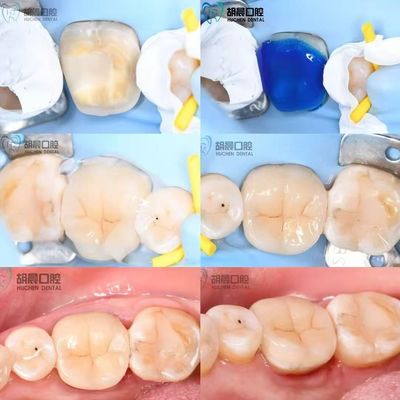 Doświadcz precyzji wkładki dentystycznej niedrogiej i białej dla doskonałego dopasowania