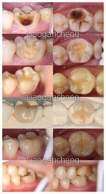 Porcelanowy zęb odnawialny dla dorosłych i dzieci wyjątkowa wydajność