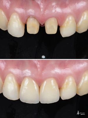 Płytki wykonane z wysokiej odporności na złamania Zirkonia dentystyczna i wielowarstwowa technologia gradientu