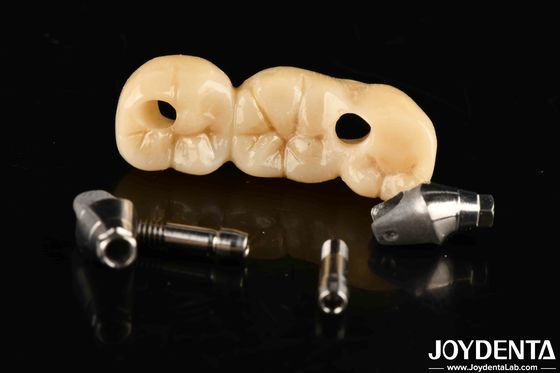 Silny implant Korona i most doskonałe rozwiązanie dla estetycznej estetyki