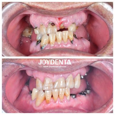 Odporne na zużycie i deformacje Zirkonia Korony dentystyczne Trwałe i odpowiednie do odbudowy tylnej i przedniej części