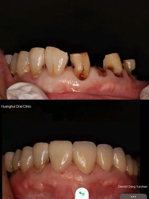 Korony Premium Zirconia dla Globalnych Laboratoriów Dentystycznych | JOY Dental Lab