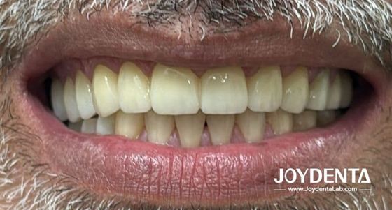 Zęby z cyrkonia, naśladujące naturalne zęby