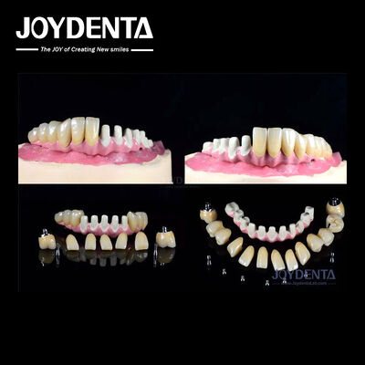 Wielokrotne implanty dentystyczne wewnętrzne do odbudowy całego łuku