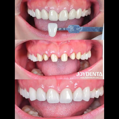 Badanie przypadku Zirconia Dental Crown Global Lab Outsourcing - Joydentalab