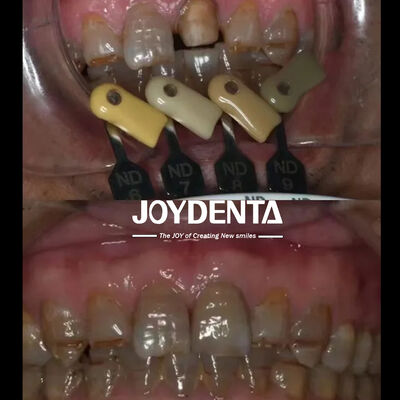 Przejrzystość Zirkonia Korony wielowarstwowa technologia gradientu